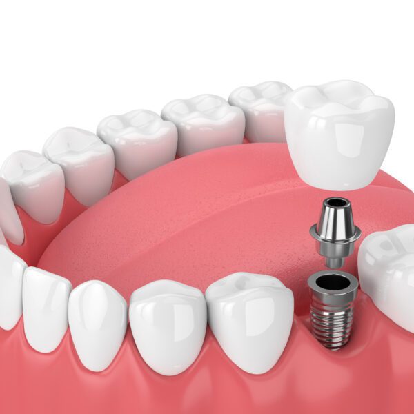 3D Render of Dental Implant Great Northern Dental Care Kalispell MT