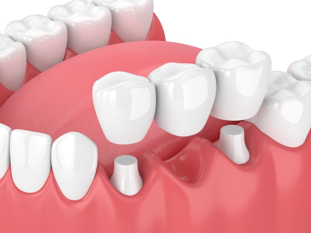 dental bridges dentist Kalispell