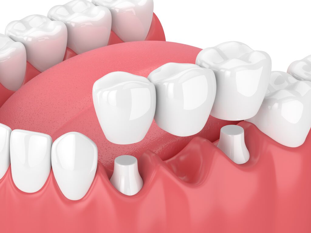 Dental Bridges 3D Render Great Northern Dental Care Kalispell MT