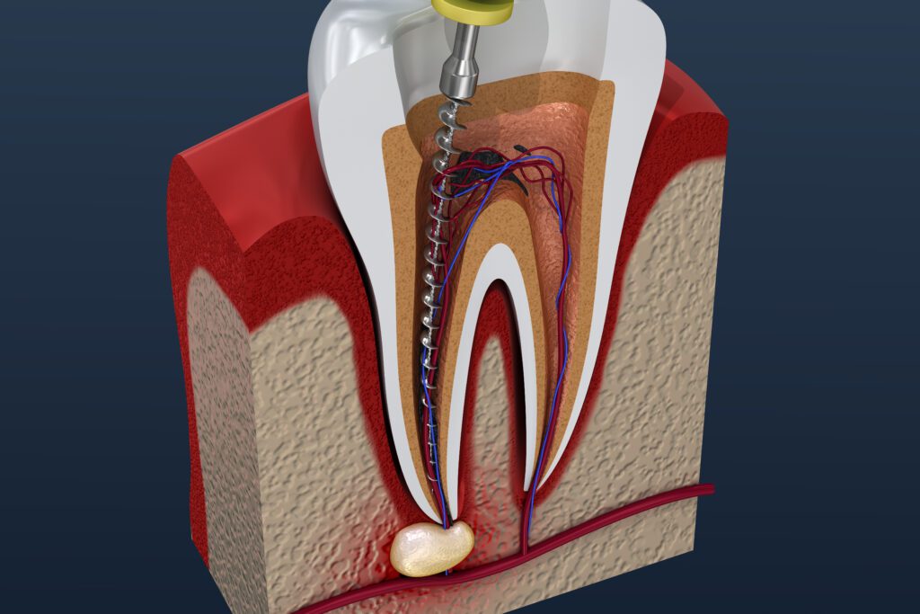 Root Canal Treatment Process at Great Northern Dental Care Kalispell MT