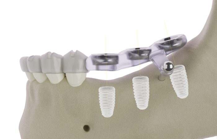 Surgical guide Surgical guide